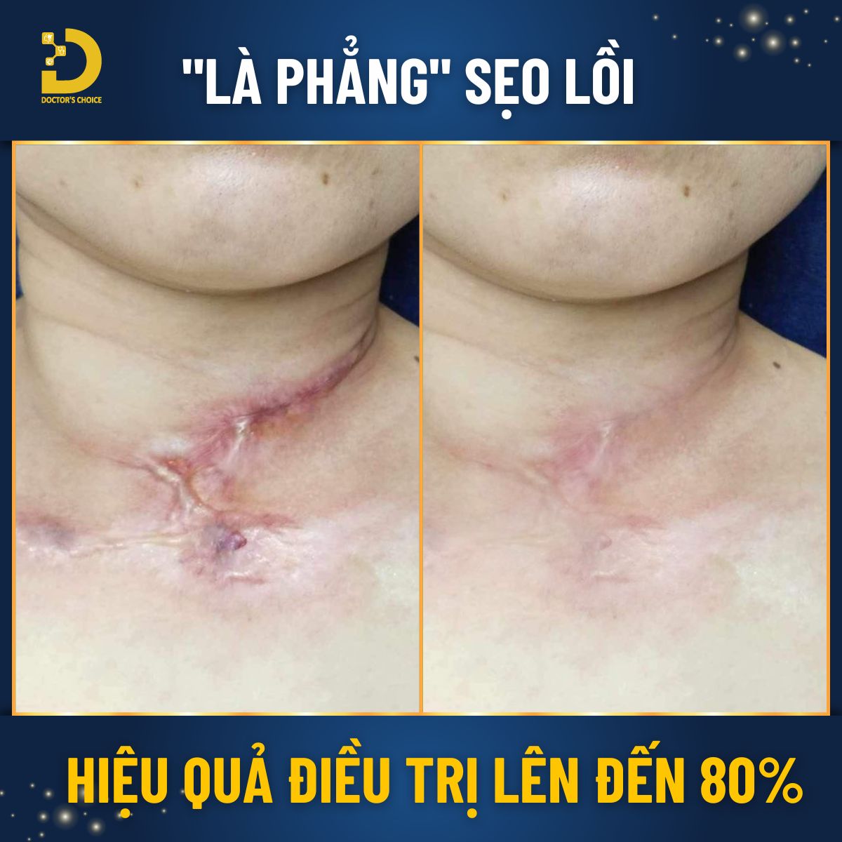 Doctor's Choice Clinic tự hào với nhiều năm kinh nghiệm chuyên sâu trong lĩnh vực điều trị sẹo lồi