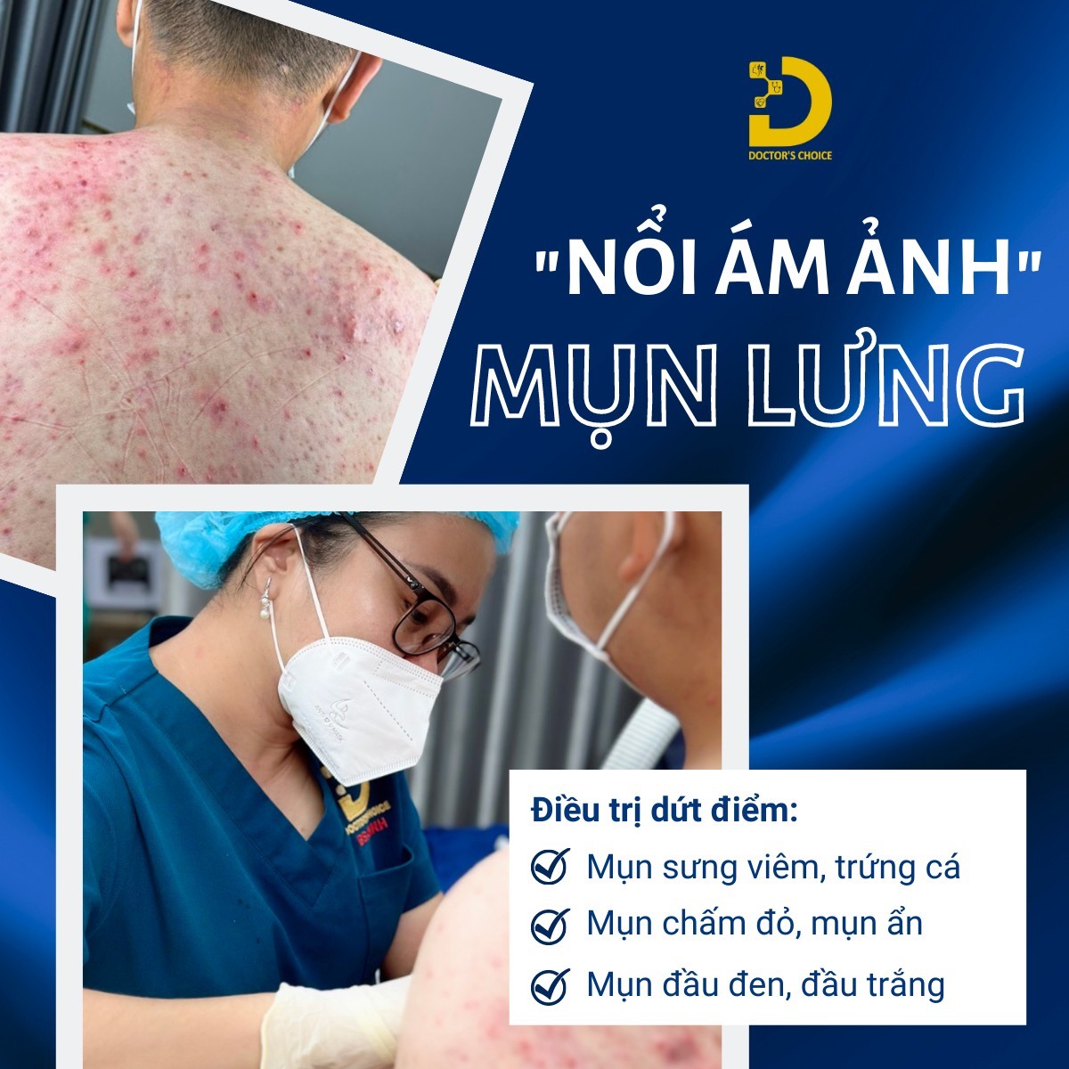 Dịch vụ điều trị mụn lưng tận gốc, dứt điểm, an toàn