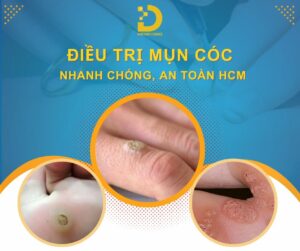 Doctor's Choice Clinic mang đến dịch vụ điều trị mụn cóc tiên tiến, an toàn và hiệu quả.