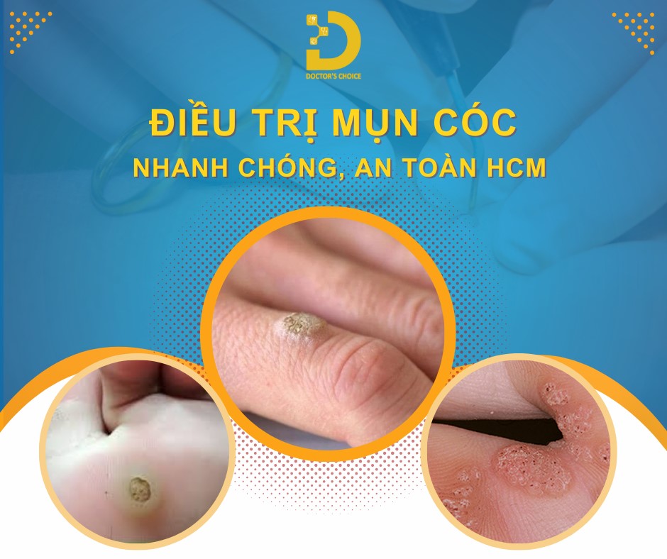 Doctor's Choice Clinic mang đến dịch vụ điều trị mụn cóc tiên tiến, an toàn và hiệu quả.