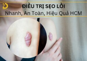 Dịch vị điều trị sẹo lồi hiệu quả tại HCM