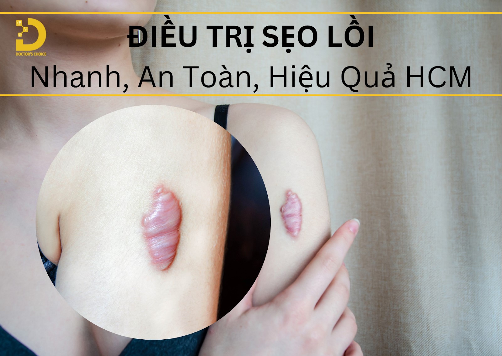 Dịch vị điều trị sẹo lồi hiệu quả tại HCM