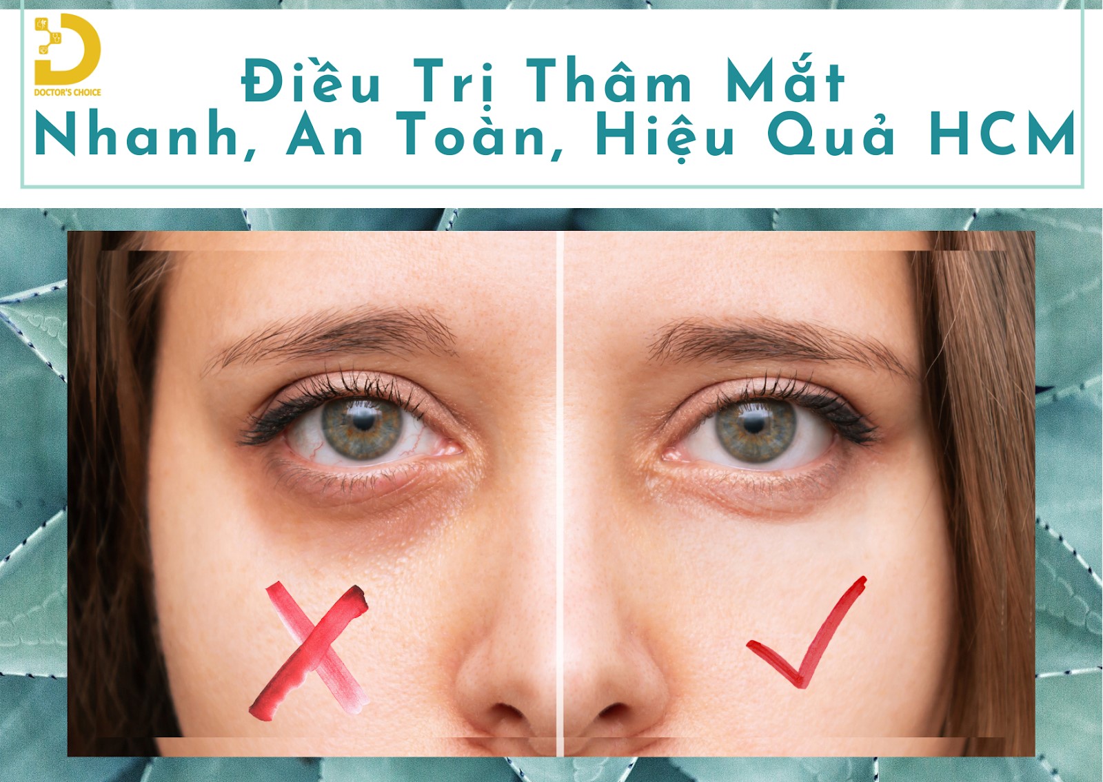 dieu tri tham mat hcm