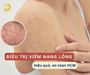 Dịch vụ điều trị viêm nang lông