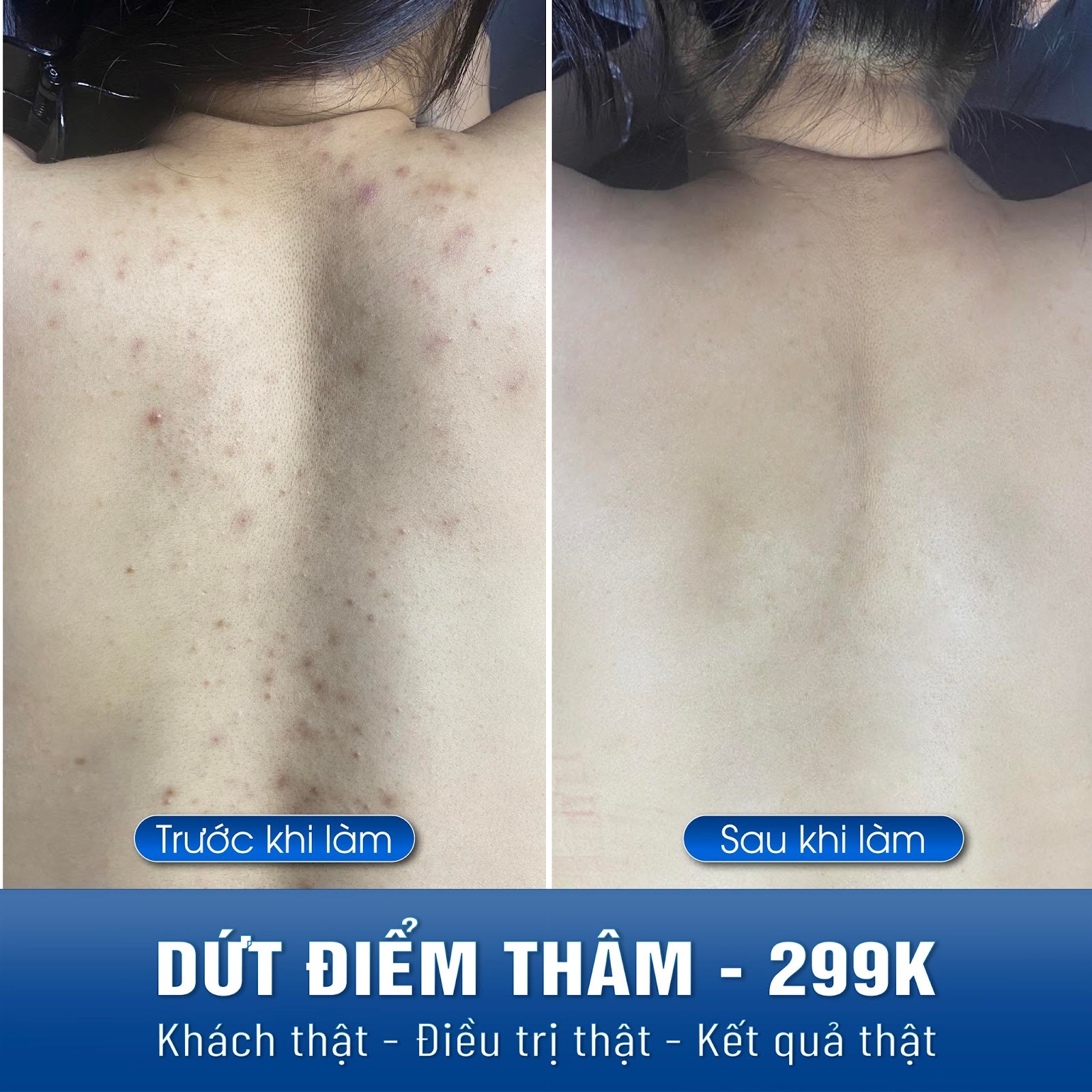 hinh anh ket qua tri mun lung 2