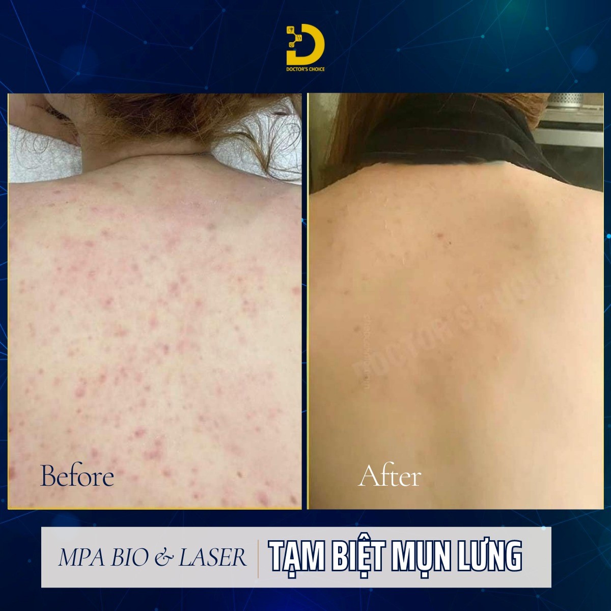 hinh anh ket qua tri mun lung 3