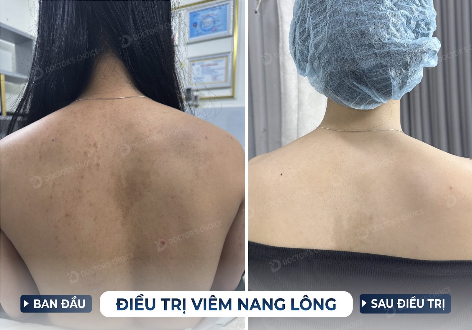 Kết quả điều trị viêm nang lông bằng laser
