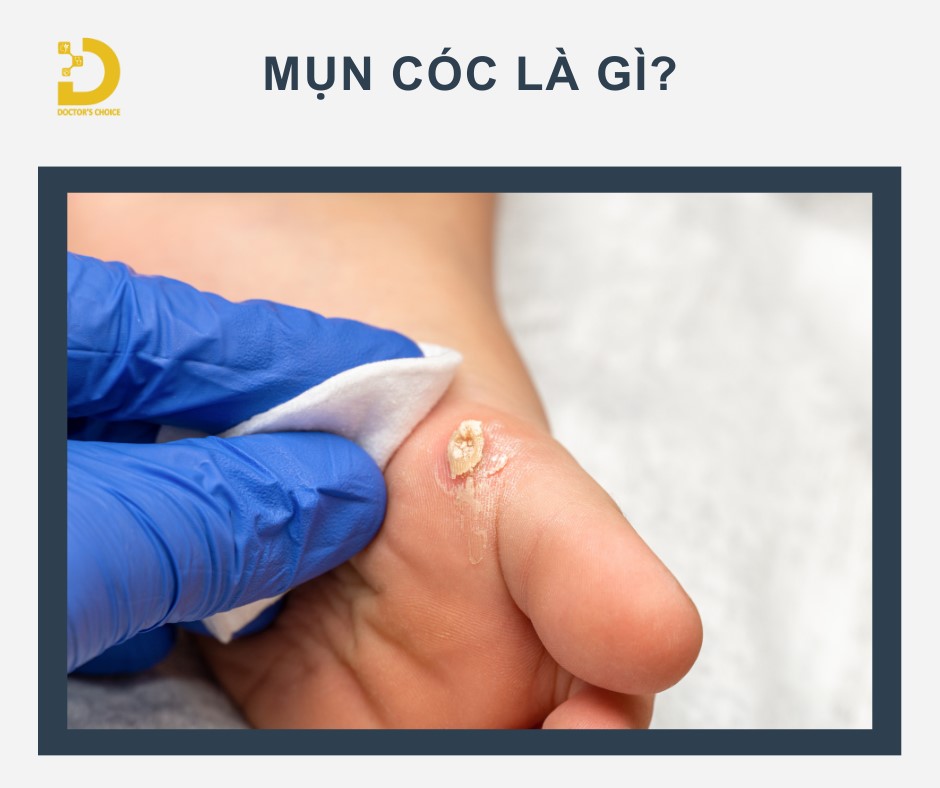Mụn cóc (Verruca) là tổn thương da dạng sùi, gồ ghề, thường có màu hơi ngả vàng hoặc nâu