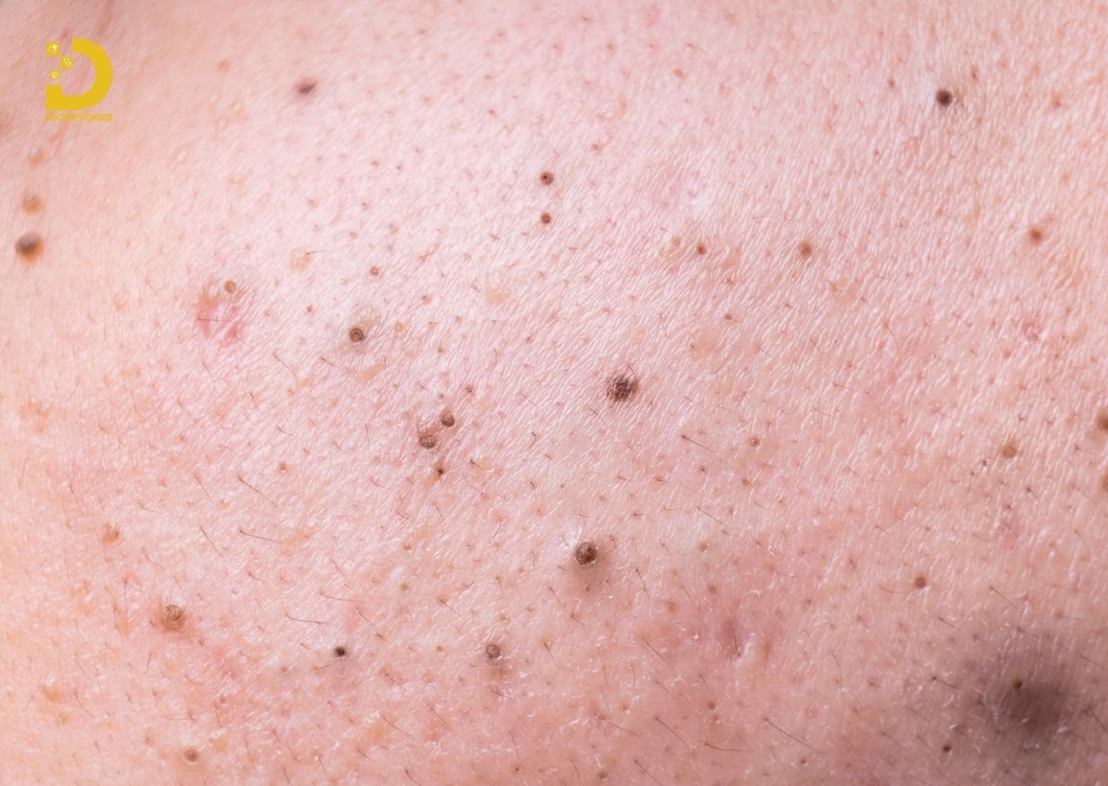 Mụn lưng đầu đen