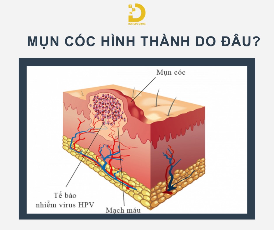 Nguyên nhân chính gây mụn cóc là do virus HPV xâm nhập vào da qua các vết thương hở.