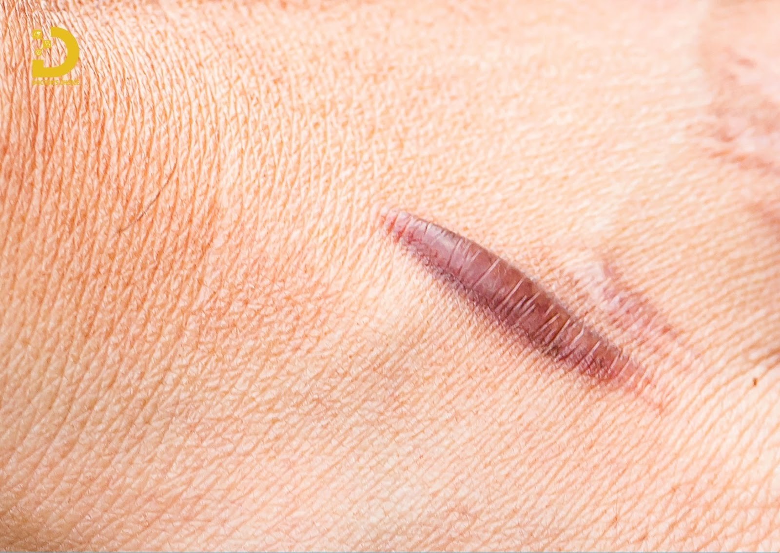 Sẹo lồi (Hypertrophic scar) là một dạng sẹo bất thường