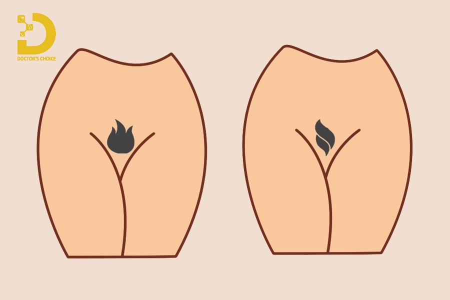 tạo hình triệt lông bikini được ưa chuộng