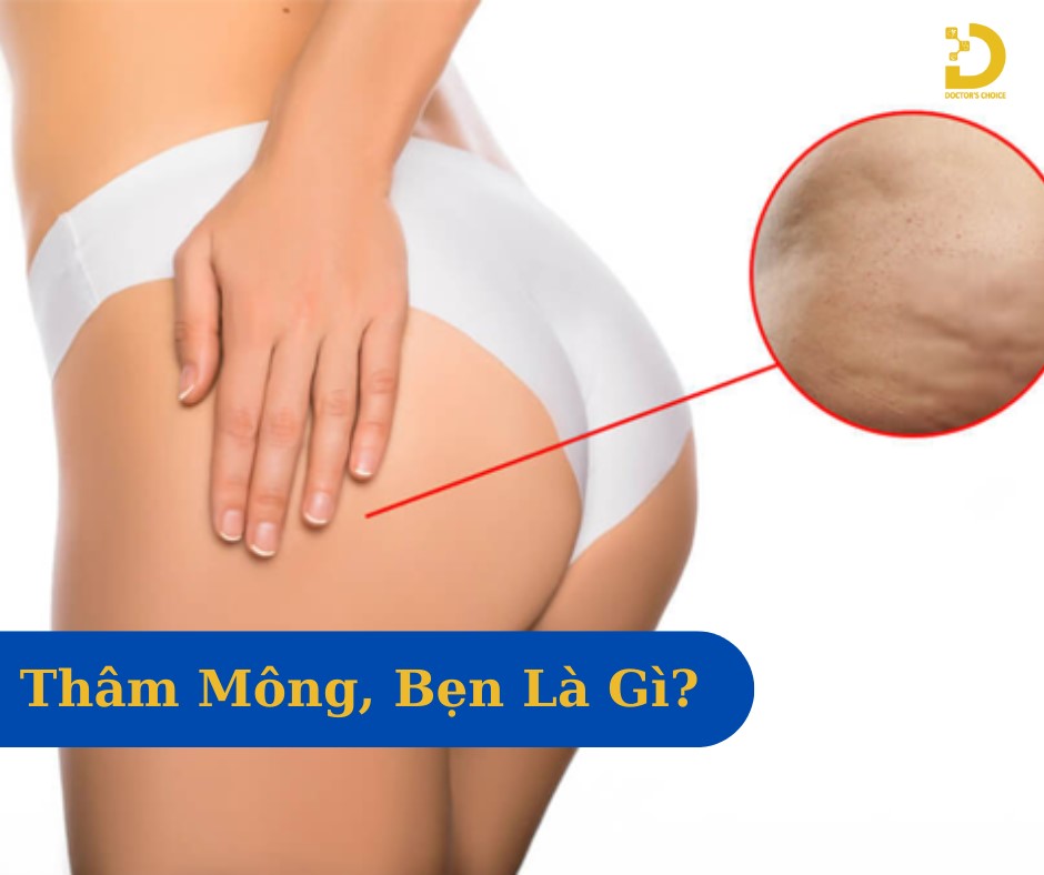 Thâm mông và bẹn là tình trạng thay đổi sắc tố da ở vùng mông và bẹn