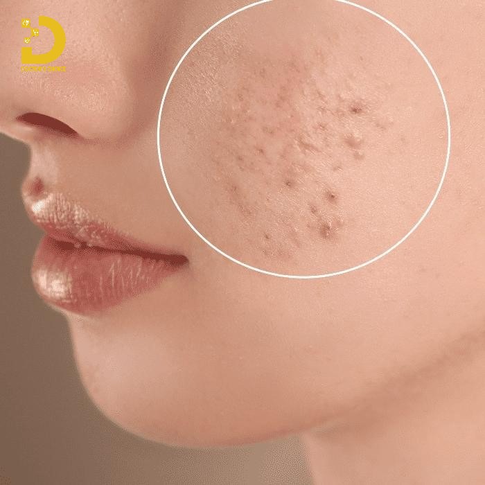 Hình ảnh da mặt bị thâm mụn