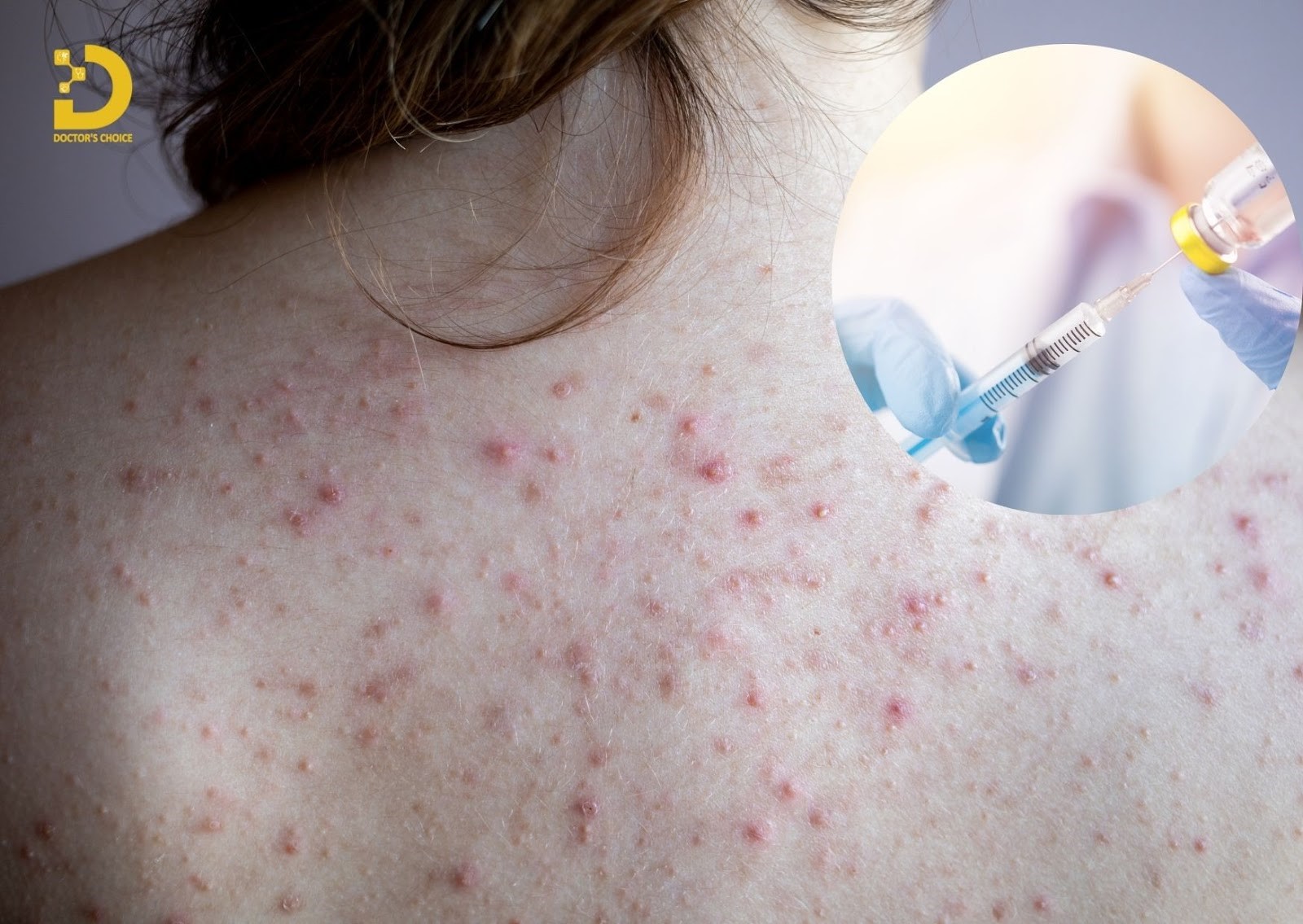 Trị mụn lưng bằng phương pháp tiêm corticosteroid nội tổn thương