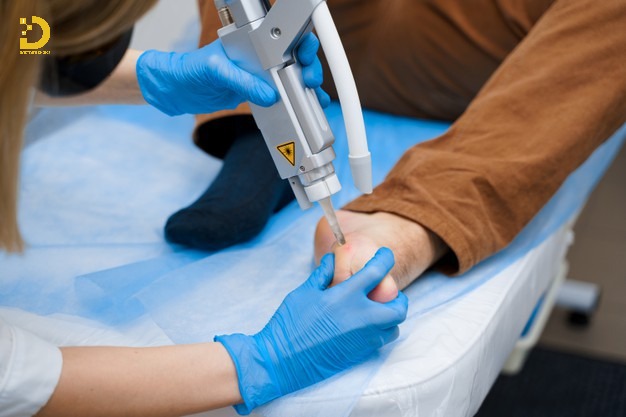 Laser là phương pháp điều trị mụn cóc tiên tiến