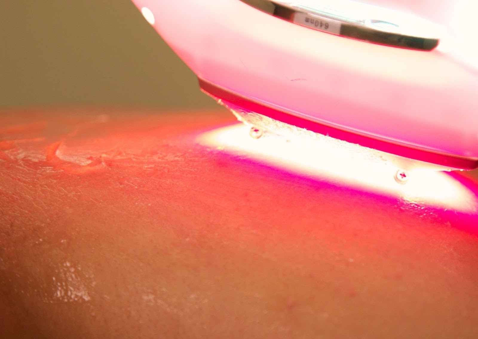 Trị mụn lưng bằng liệu pháp ánh sáng