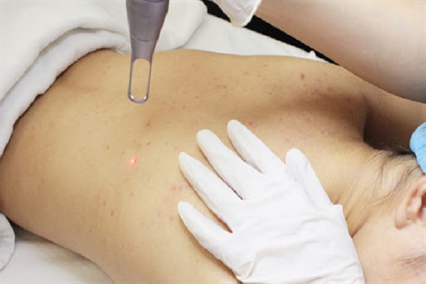 Trị mụn lưng bằng công nghệ Laser CO2 Fractional