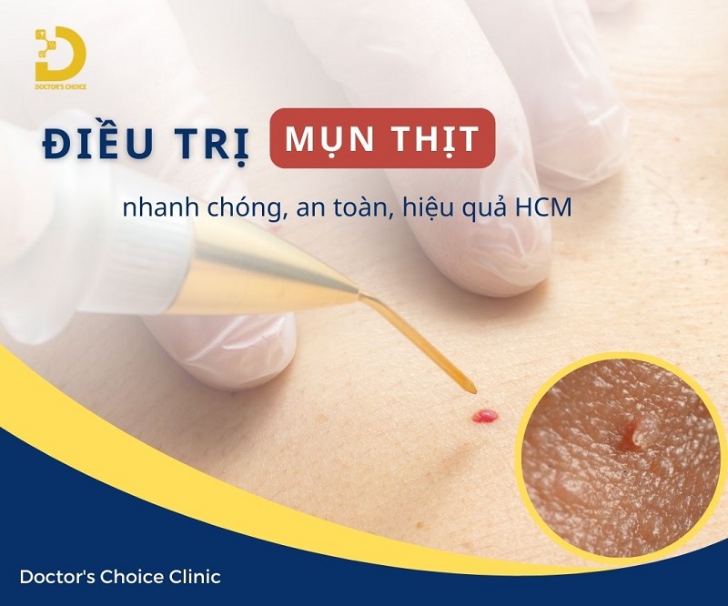 Điều trị mụn thịt