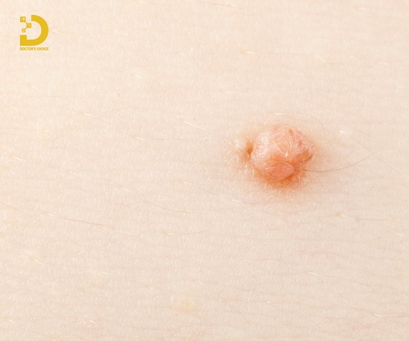 Nguyên nhân gây nên mụn thịt