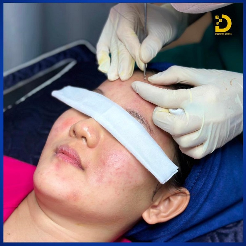 Dịch Vụ Điều Trị Mụn Viêm Hiệu Quả Nhanh, An Toàn Chuẩn Y Khoa HCM 12 tri mun viem 3