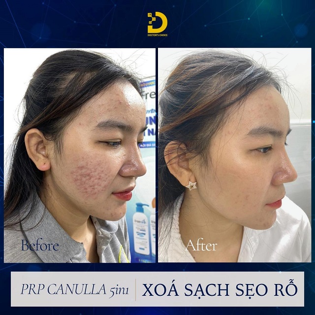 tri seo ro seo lom 13