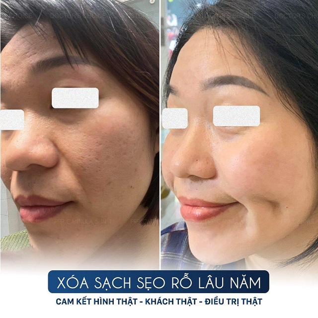 tri seo ro seo lom 16