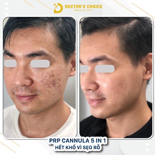 tri seo ro seo lom 17