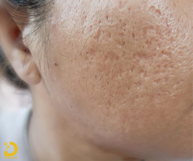 tri seo ro seo lom 4