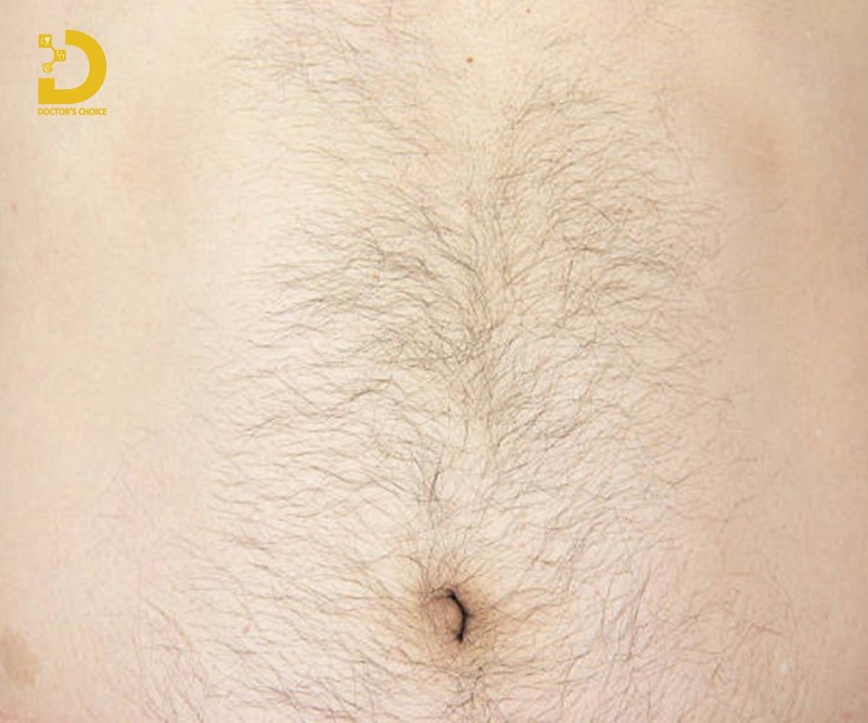 Dịch Vụ Triệt Lông Bụng Tận Gốc, An Toàn Tại HCM 7 triet long bung 2