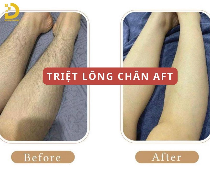 Dịch Vụ Triệt Lông Chân An Toàn Tận Gốc Tại HCM 10 triet long chan 4