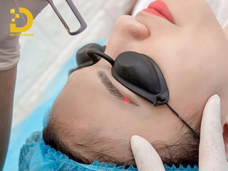 Thời gian thực hiện triệt lông mày bằng Laser Diode, SHR chỉ khoảng 15-30 phút