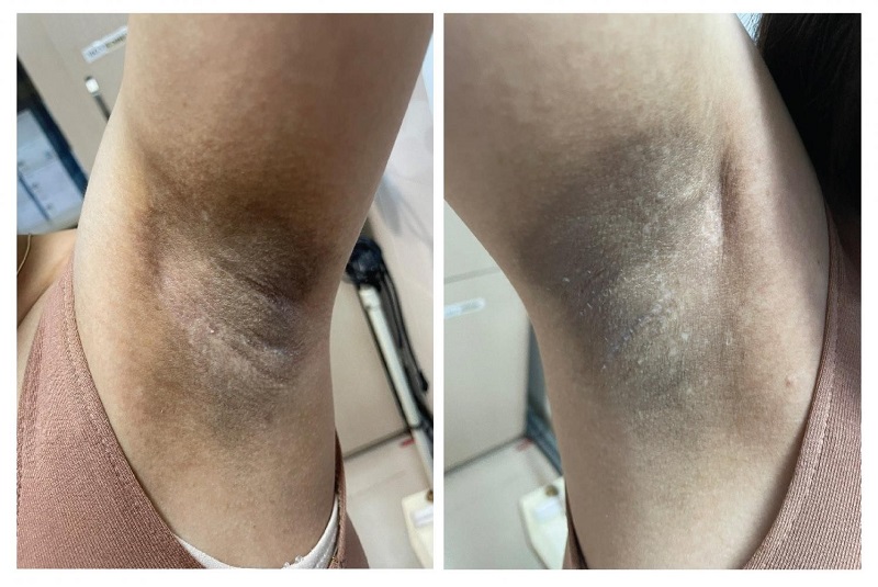 Triệt Lông Nách Tận Gốc Vĩnh Viễn, An Toàn HCM 10 Triệt lông nách sai cách gây thâm sạm, sẹo, rối loạn sắc tố da