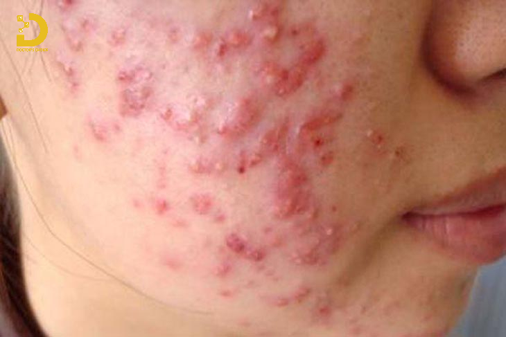 Viêm nang lông sâu