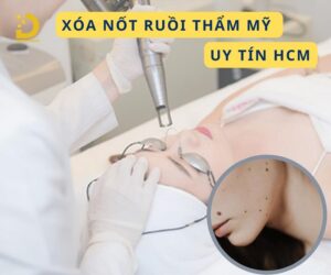 xoa not ruoi tham my 1