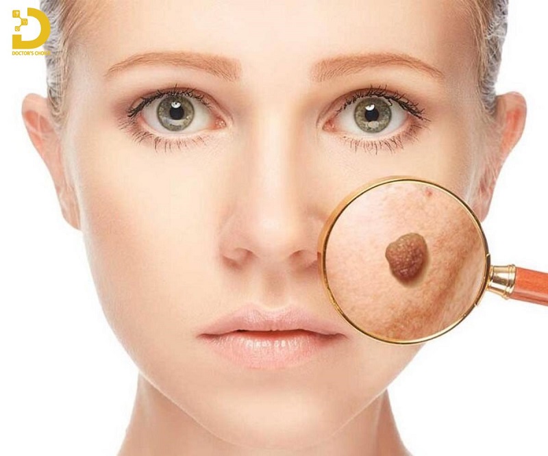 xoa not ruoi tham my 2