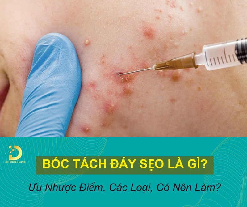 Bóc tách đáy sẹo là gì