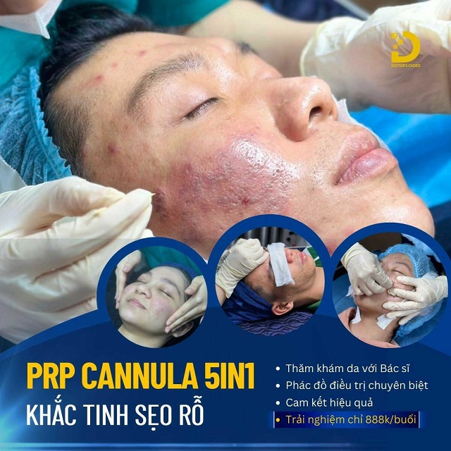 Bóc tách đáy sẹo bằng ống Cannula