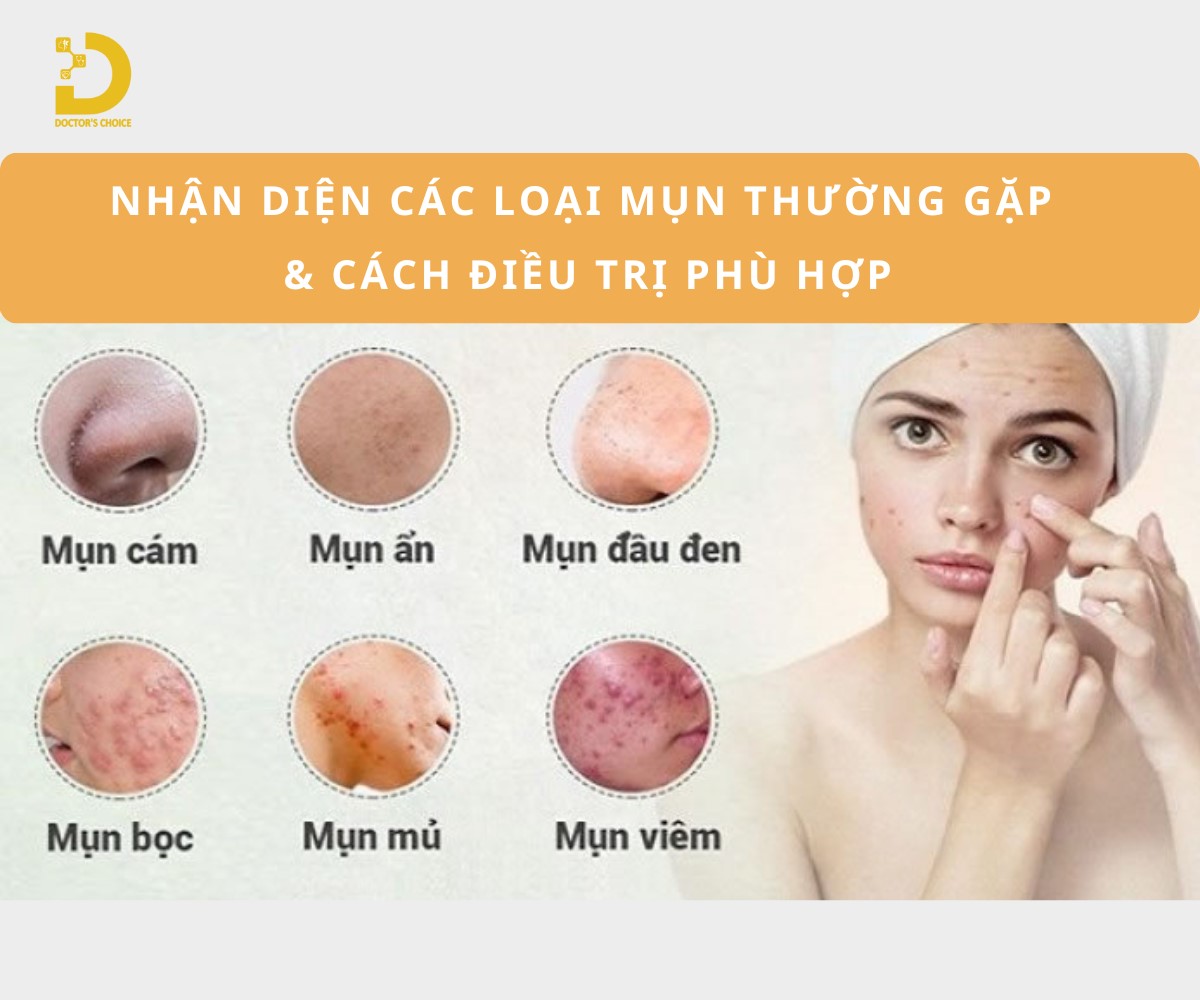 Các loại mụn thường gặp và cách điều trị phù hợp