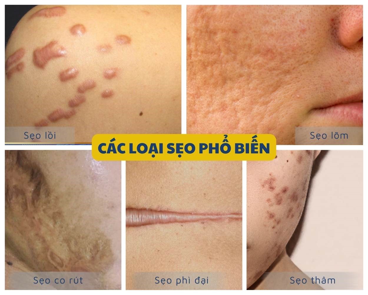 Các loại sẹo phổ biến hiện nay