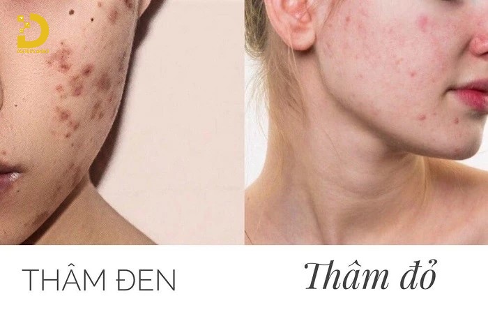 Các loại thâm mụn phổ biến