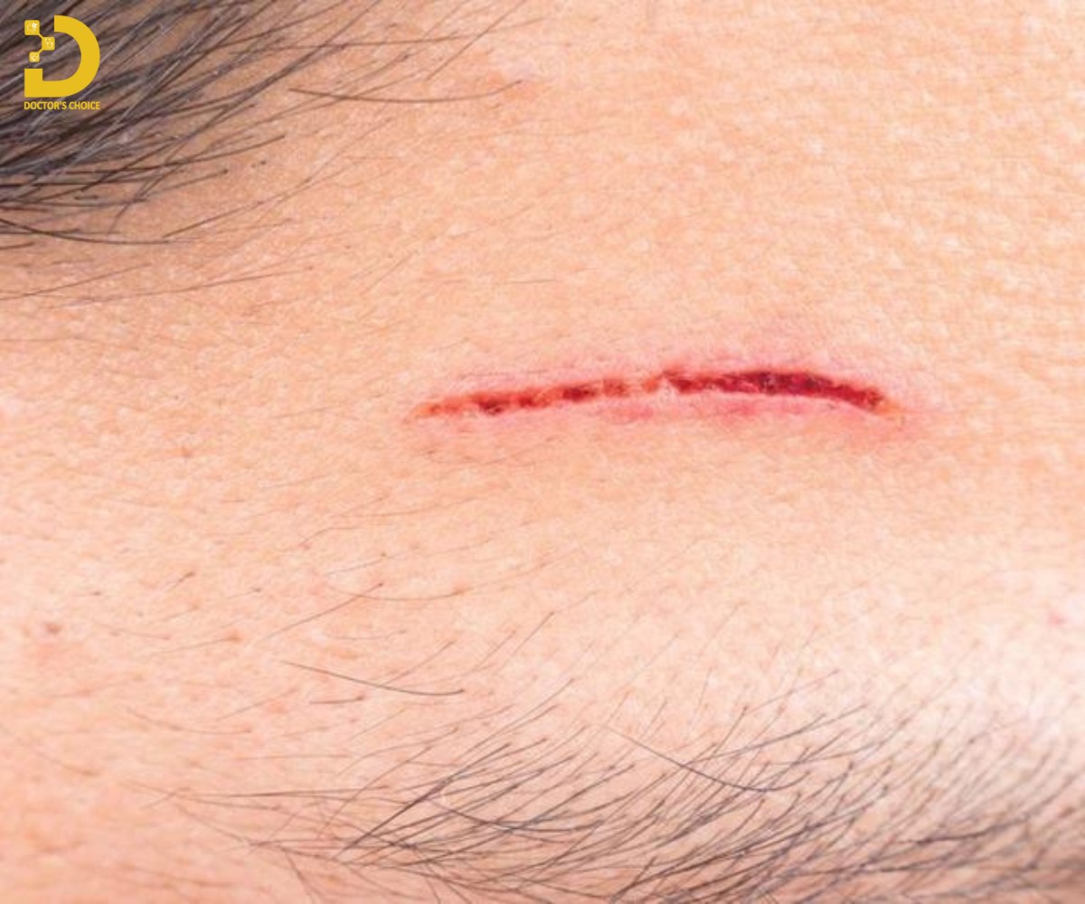 Các yếu tố ảnh hưởng quá trình lành vết thương