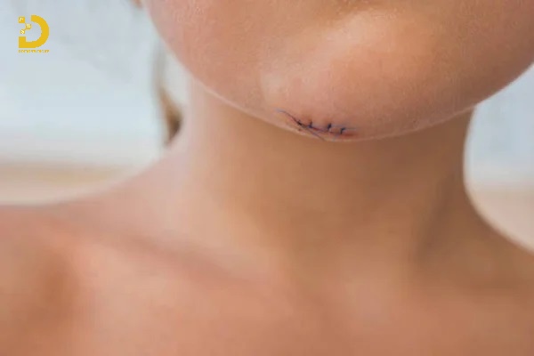 Theo giỏi vết thương trong quá trình tái tạo