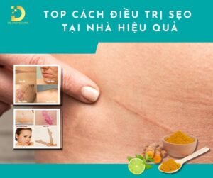cách điều trị sẹo tại nhà