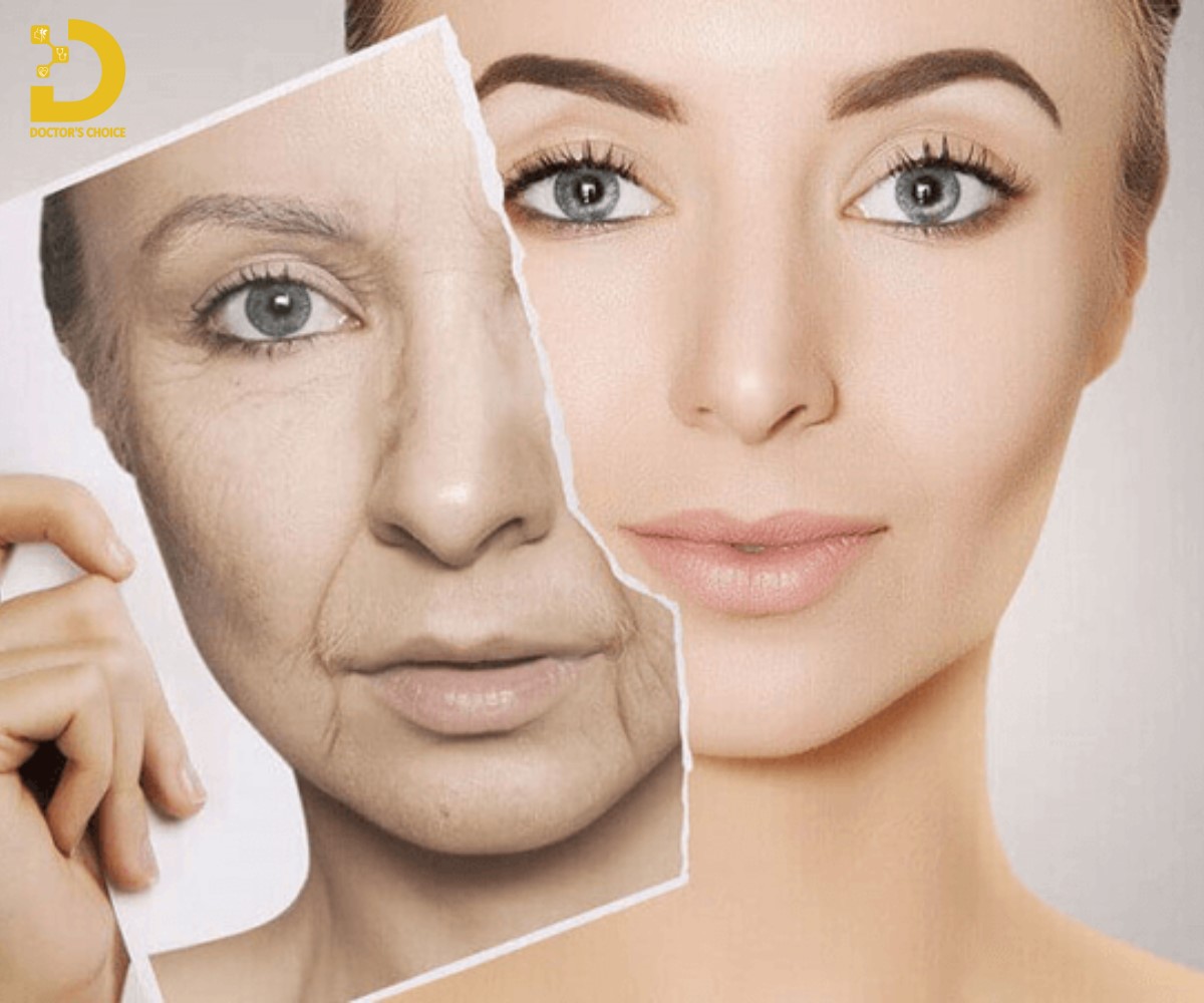 Nhược điểm của căng chỉ trẻ hóa da