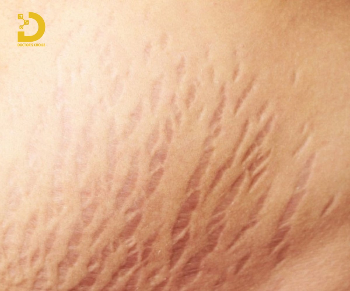 Sẹo giãn biểu hiện qua các dấu hiệu như đường rạn da, sự thay đổi màu sắc trên da, ngứa, đau.