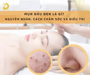 Tìm hiểu về mụn đầu đen và cách điều trị hiệu quả