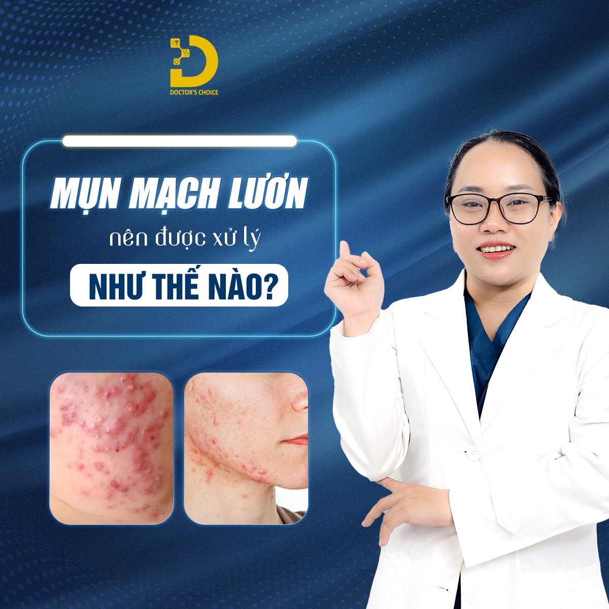 Các phương pháp điều trị mụn mạch lươn hiệu quả