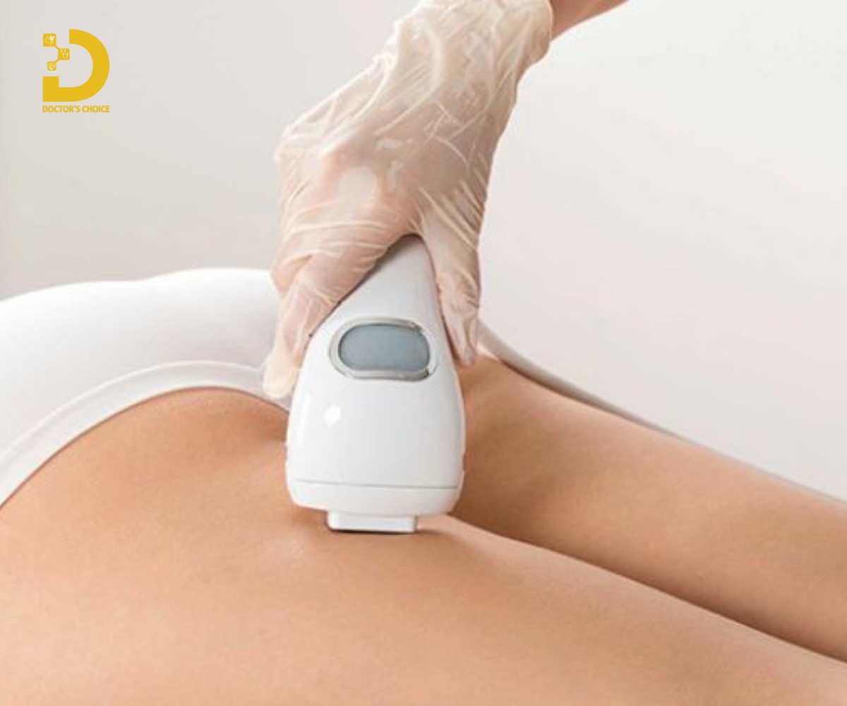 Điều trị sẹo giãn bằng laser