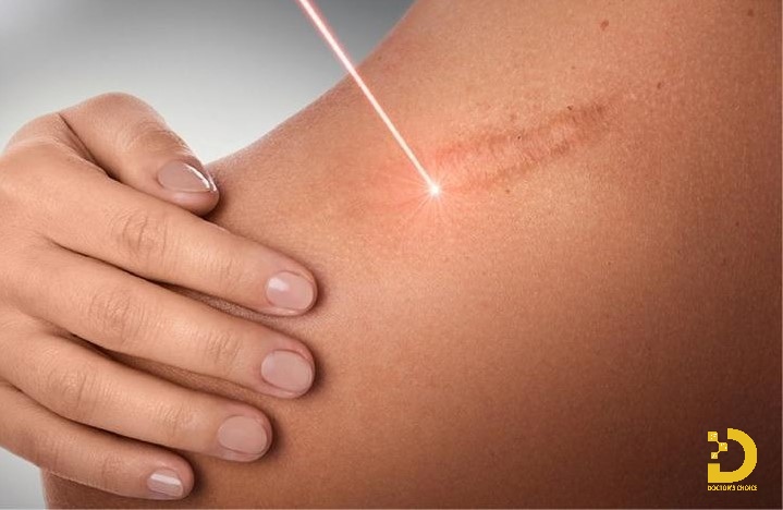 Phương pháp điều trị sẹo bằng Laser
